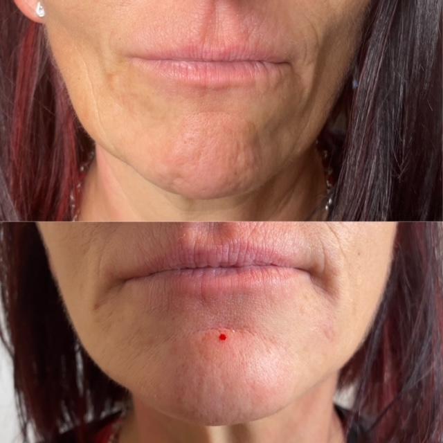 dermal fillers solihull | botox solihull