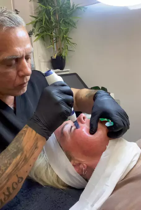 microneedling at arya clinic