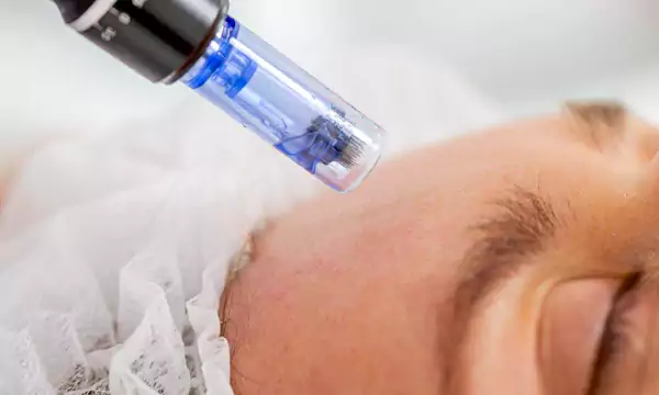 microneedling on womans face